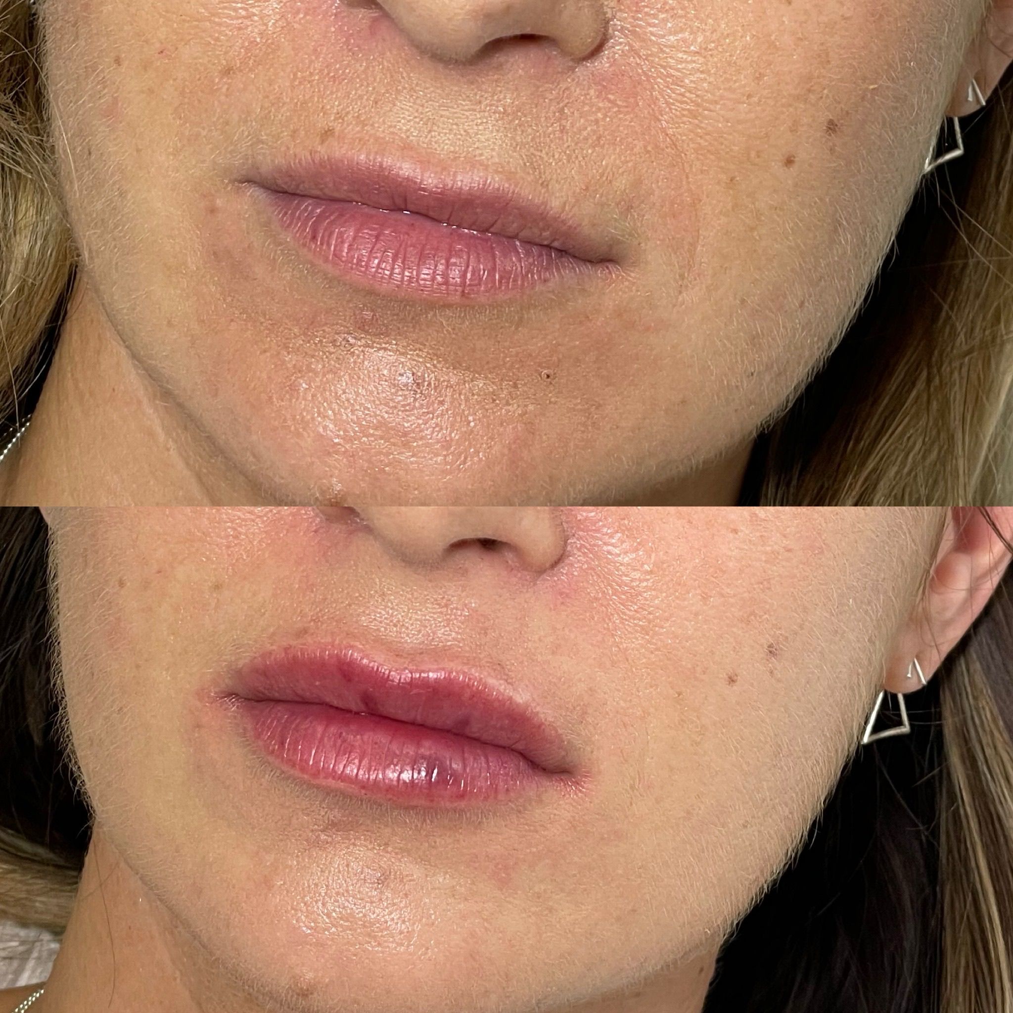 Lip Fillers, Botox, Dermal Fillers, Anti-Wrinkle Injections in East Acton W3 post thumbnail image